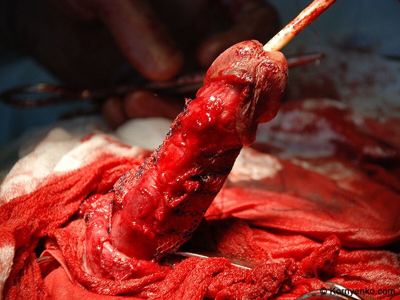 инсталација на колагенска матрица за зголемување на пенисот