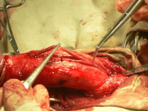 изведување операција за зголемување на пенисот