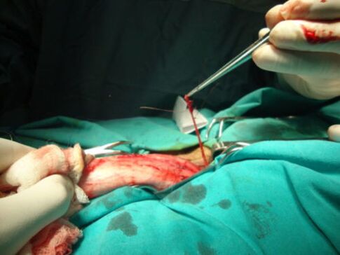 операција за зголемување на пенисот