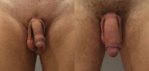 пред и по операција за зголемување на пенисот